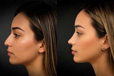 Antes y después de Rinoplastia secundaria