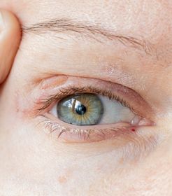 Blefaroplastia sin cirugía