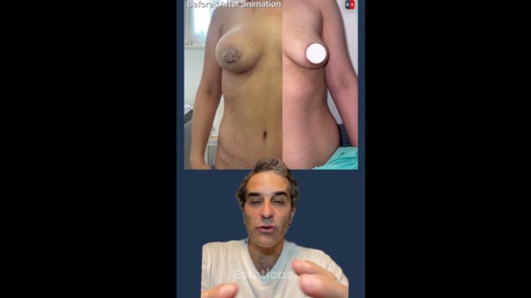 Mastopexia - Dr. Diego Cunille