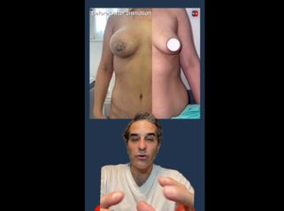 Mastopexia - Dr. Diego Cunille