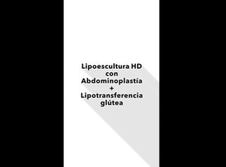 Lipoescultura HD + abdominoplastia + lipotransferencia glútea