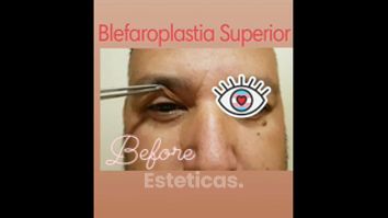 Blefaroplastia