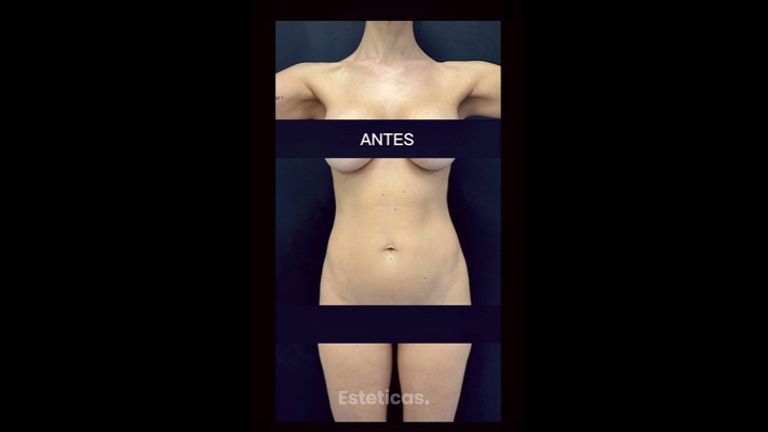 Liposucción - Dr. Cristian Gänsslen