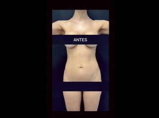 Liposucción - Dr. Cristian Gänsslen