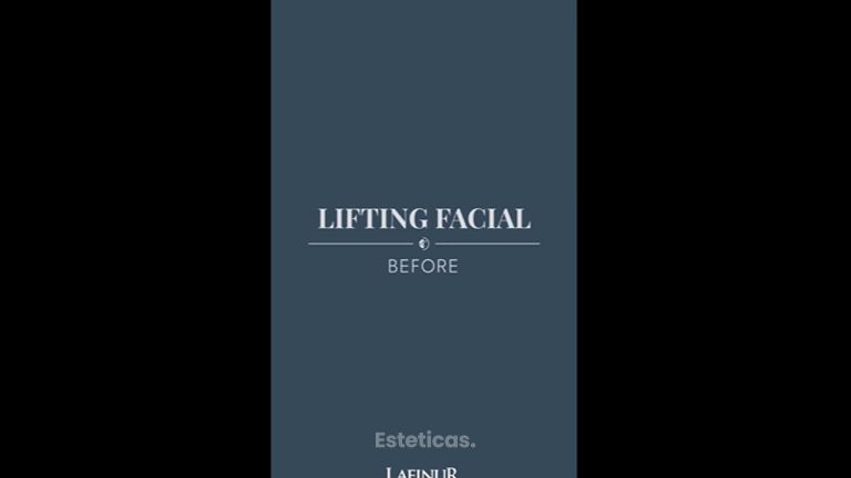 Lifting facial - Dr. Federico Coccaro