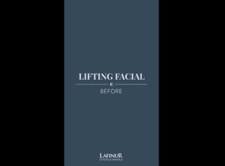 Lifting facial - Dr. Federico Coccaro