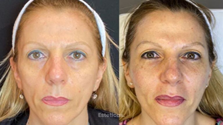 Tratamienteo FULL FACE - Antes y después - Dra. Romina Neira