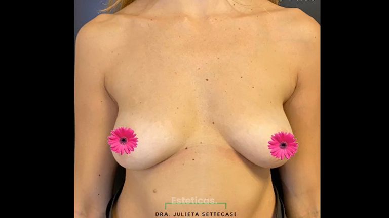 Aumento mamas - Dra. Julieta Settecasi