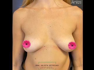 Aumento mamas - Dra. Julieta Settecasi
