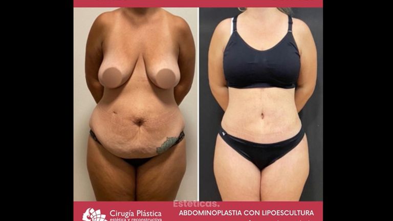 Abdominoplastia - Dr. Emmanuel Manavela Chiapero