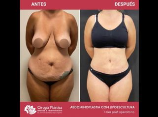 Abdominoplastia - Dr. Emmanuel Manavela Chiapero