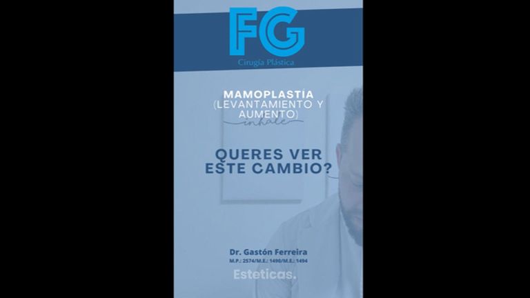 Aumento de mamas - Dr. Gastón Eduardo Ferreira