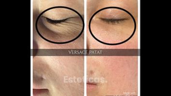 Eliminación de las ojeras
