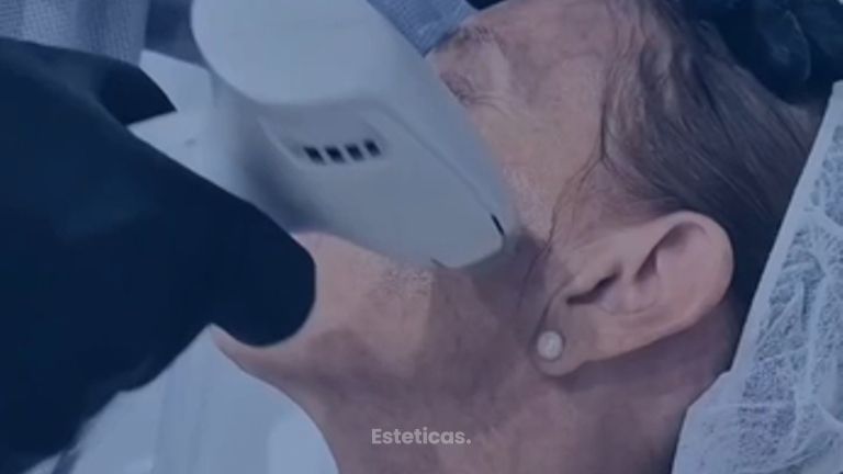 Frax Face Radiofrecuencia Facial - Dr. Damián Wengrowicz