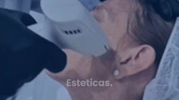 Frax Face Radiofrecuencia Facial - Dr. Damián Wengrowicz