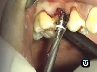 Consigue la mejor de las dentaduras