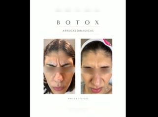 Botox