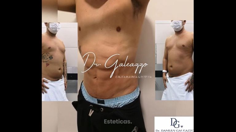 Renuvion Vaser Marcación abdominal  - Dr. Damián Galeazzo