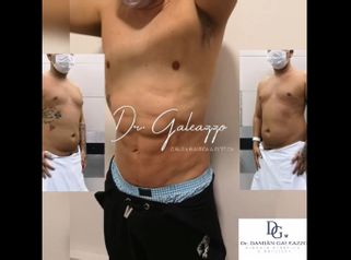 Renuvion Vaser Marcación abdominal  - Dr. Damián Galeazzo