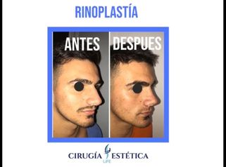 Rinoplastia