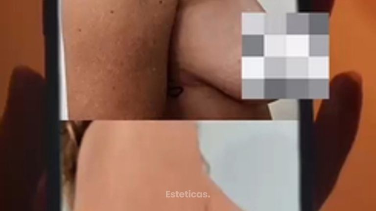 Mastopexia - Dr. Matias Llabres