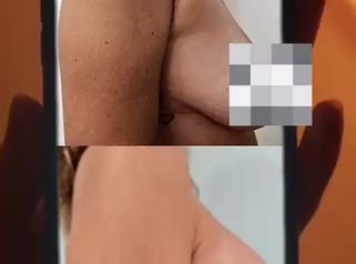 Mastopexia - Dr. Matias Llabres