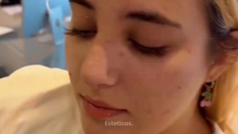 Rinoplastia - Dr. Agustín Matia