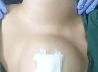 Aumento mamas - Dr. Lucas Sánchez