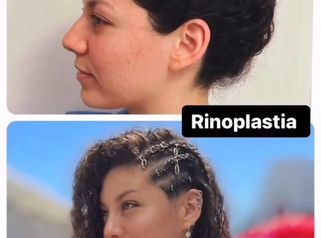 Rinoplastia - Dra. María de la Paz Vélez