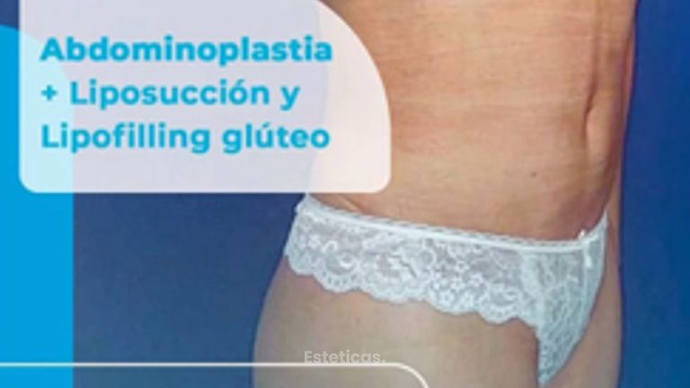 Abdominoplastia - Dr. Lucas Sánchez