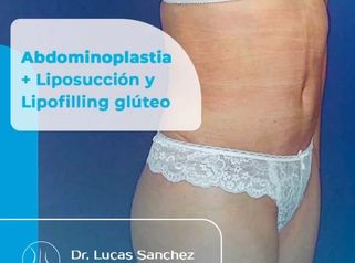 Abdominoplastia - Dr. Lucas Sánchez