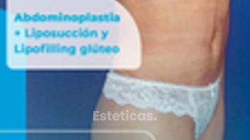 Abdominoplastia - Dr. Lucas Sánchez