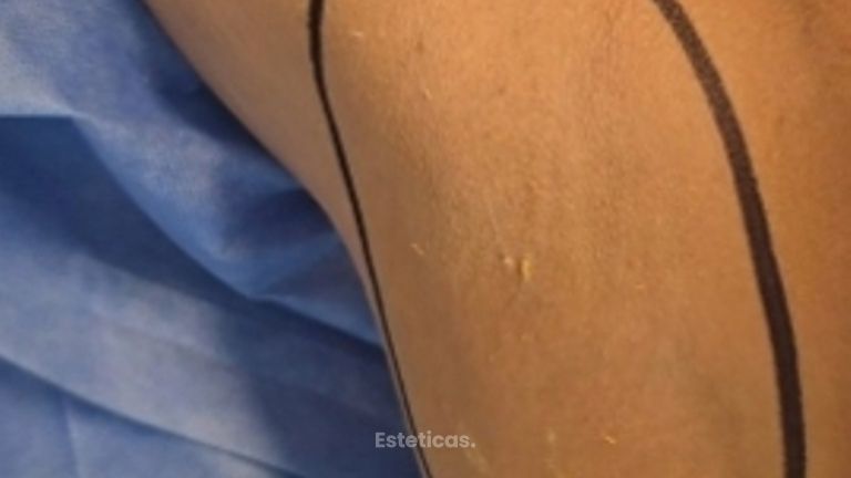 La hiperhidrosis es una sudoración excesiva - Dr. Damián Galeazzo y Equipo