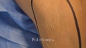 La hiperhidrosis es una sudoración excesiva - Dr. Damián Galeazzo y Equipo