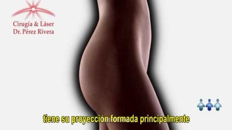 Prótesis de Glúteos - Gluteoplastía