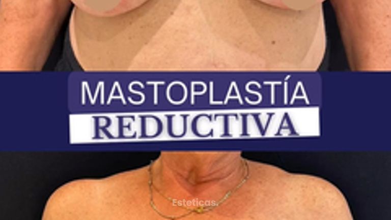Reducción mamas - Dr. Agustín Matia