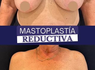 Reducción mamas - Dr. Agustín Matia