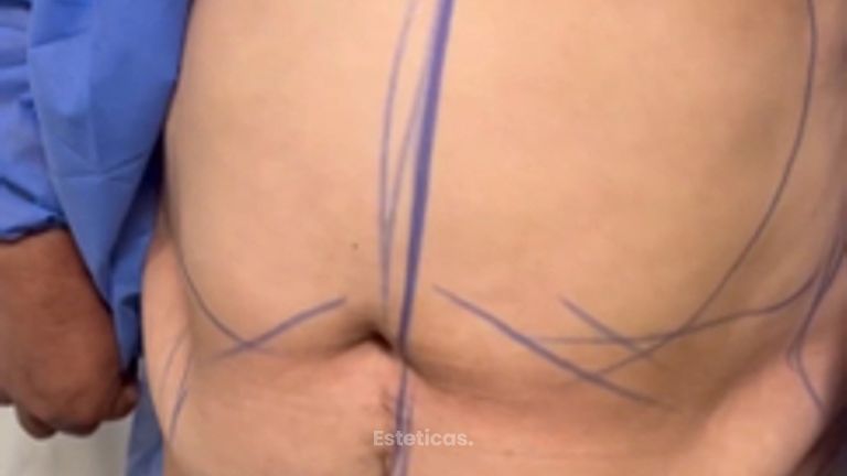 Dermolipectomía - Dr. Juan Pablo Oliver