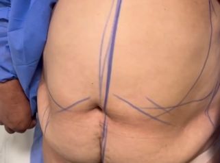 Dermolipectomía - Dr. Juan Pablo Oliver