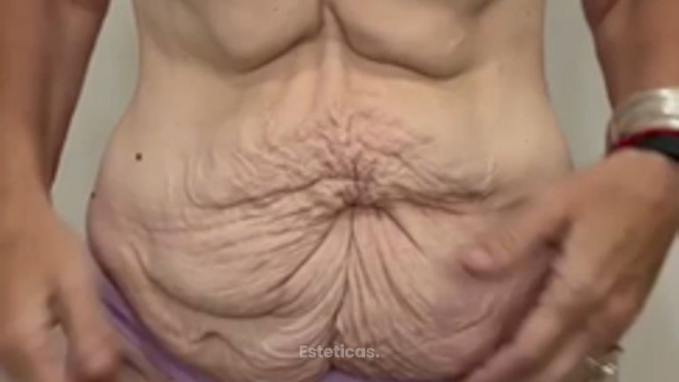 Abdominoplastia post bariátrica - con modelado glúteo - Dr. Emmanuel Manavela Chiapero