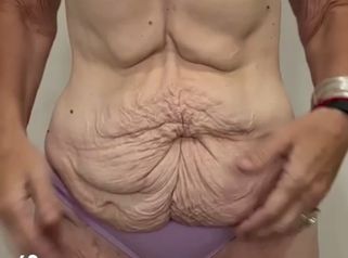 Abdominoplastia post bariátrica - con modelado glúteo - Dr. Emmanuel Manavela Chiapero
