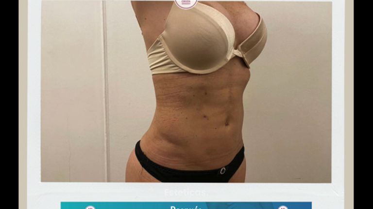 Liposucción - Mi Cirugía