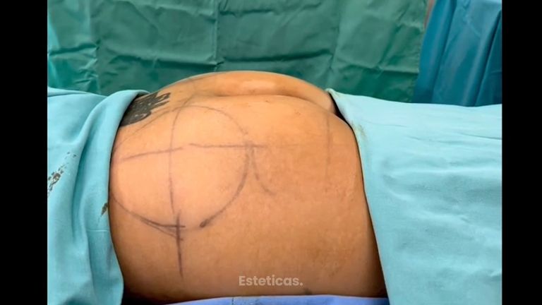 Aumento glúteos - Dr. Williams Erik Bukret