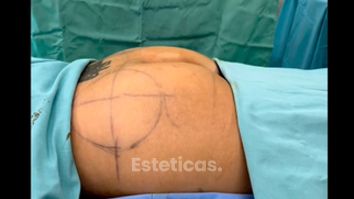 Aumento glúteos - Dr. Williams Erik Bukret