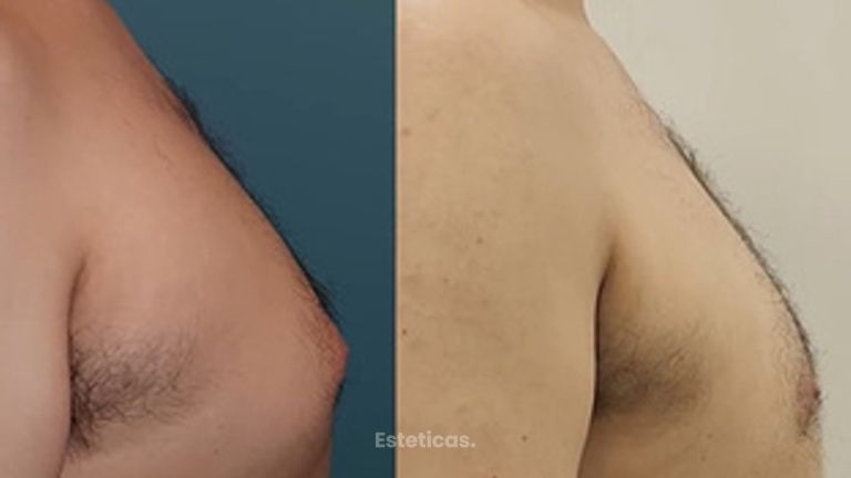 ¿Cuando aparece la Ginecomastia? - Dra. Natalia Solimano