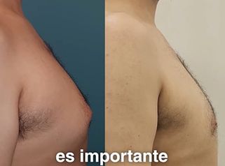 ¿Cuando aparece la Ginecomastia? - Dra. Natalia Solimano