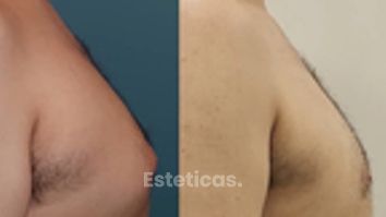 ¿Cuando aparece la Ginecomastia? - Dra. Natalia Solimano