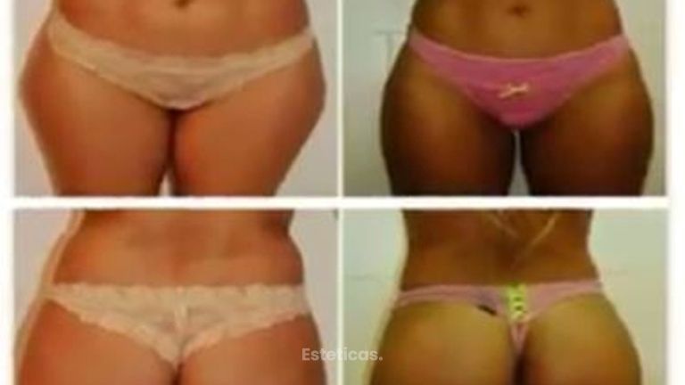 Lipoescultura con transferencia glútea.