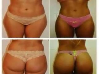 Lipoescultura con transferencia glútea.