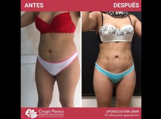 Lipoescultura - Dr. Emmanuel Manavela Chiapero